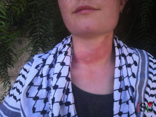 ISMer’s neck shows strangulation marks where she was dragged across the floor by Israeli border police with her Kaffiyeh. Photo: ISM
